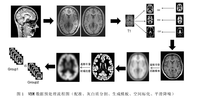 图 1 VBM 数据预处理流程图（配准、灰白质分割、生成模板、空间标化、平滑降噪）
